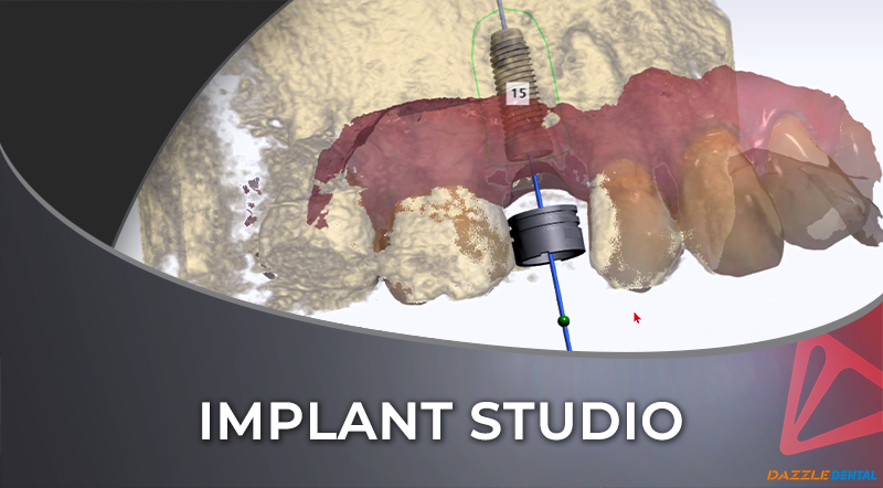 3Shape Implant Studio Workflow