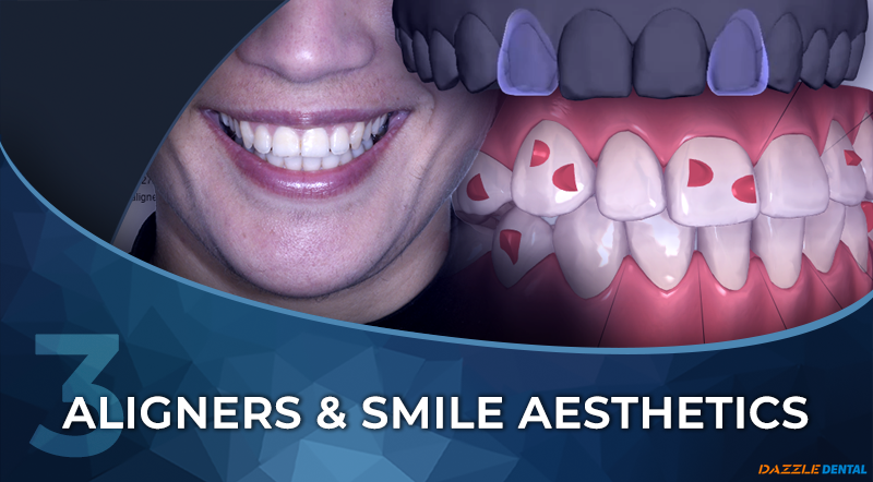An Interdisciplinary Approach to Clear Aligners