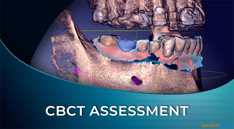 DIW 02 CBCT Assessment and Implant Planning