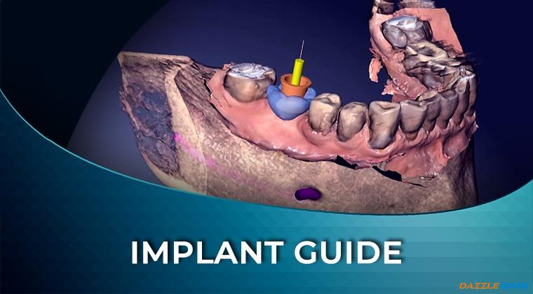 DIW 03 Single Tooth Implant Digital Workflow