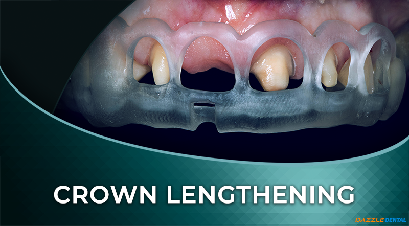 Digitally Guided Surgical Crown Lengthening + DSD