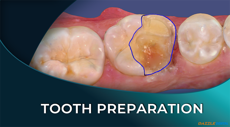 Modern Prep Design and Margination